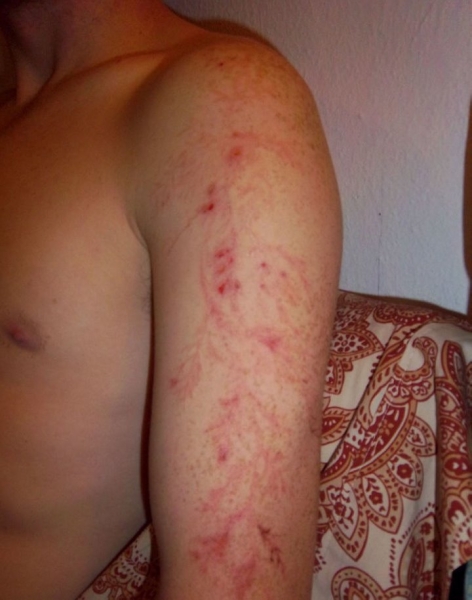 После разряда — что происходит с человеком, в которого ударила молния После разряда — что происходит с человеком, в которого ударила молния