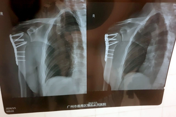 Белорус попал в аварию в Китае и испытал на себе особенности местной медицины Белорус попал в аварию в Китае и испытал на себе особенности местной медицины